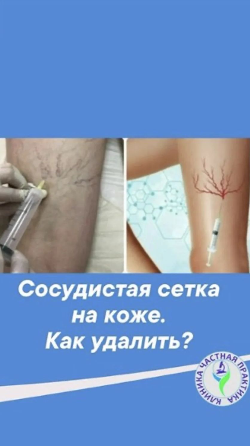 Сосудистая сетка на коже. Как убрать?