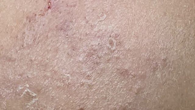 Выдавливаем подкожные угри. Расслабляющий видеоролик.