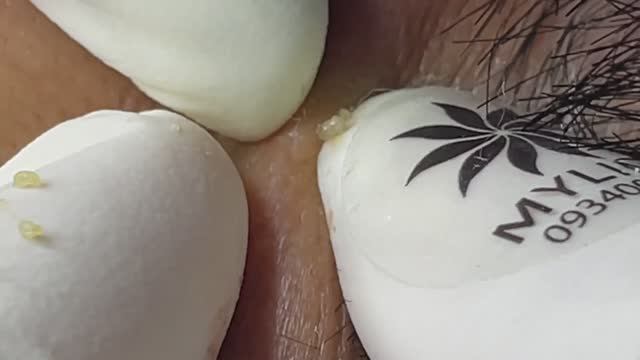 ВИЗУАЛЬНЫЙ РЕЛАКС: чистим лицо от комедонов