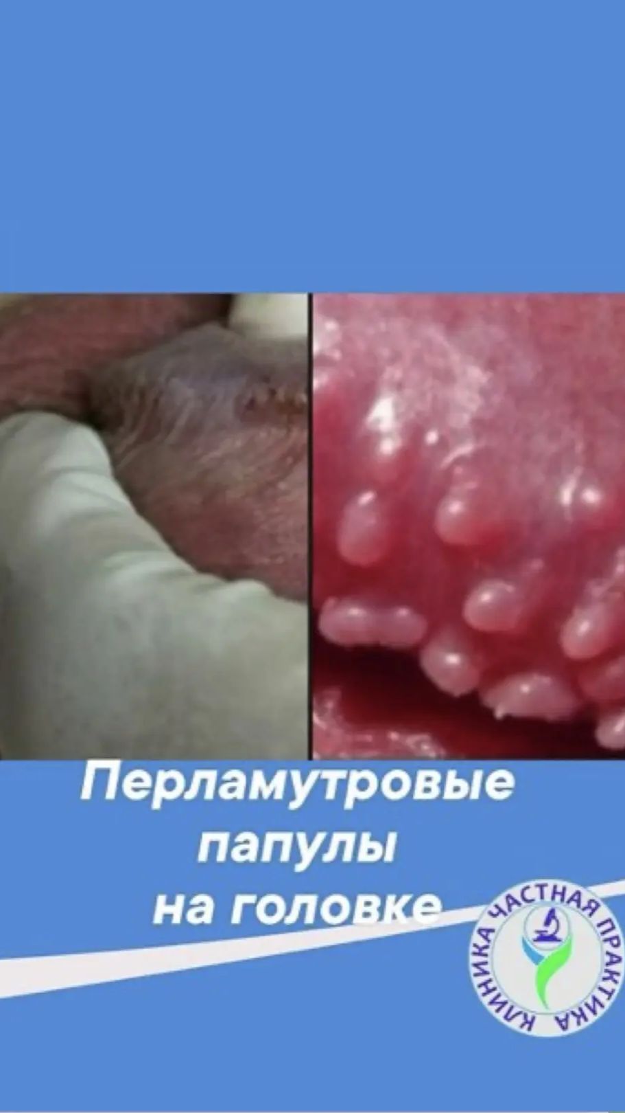 Перламутровые папулы на головке полового члена