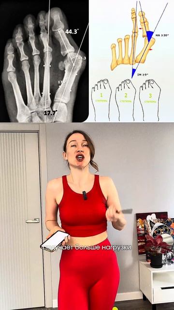 Косточка на ноге, что делать чтобы убрать