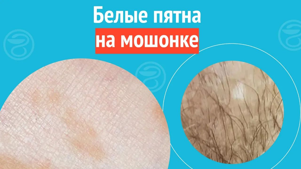 ▶️ Белые пятна на мошонке. Клинический случай №1297