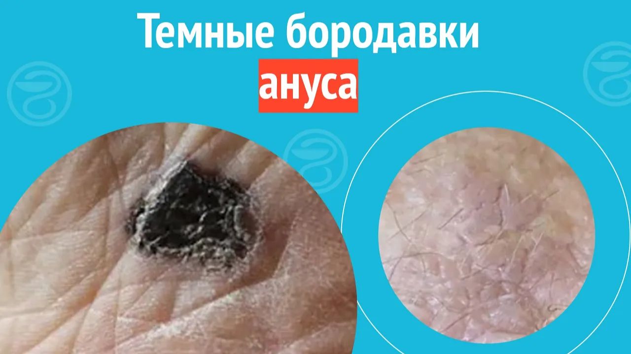 😦 Темные бородавки ануса. Клинический случай №1294