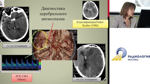 L00571 Патология сосудов головного мозга. Часть 3 Григорьева Е.В.