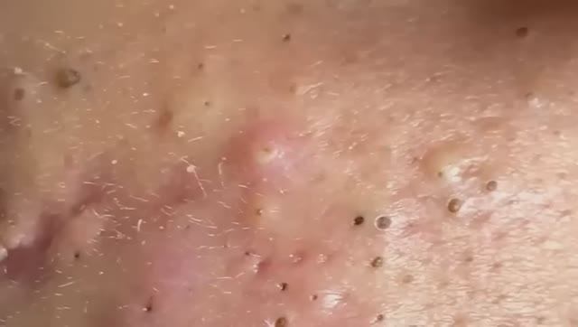 Удаление кистозного акне — работа с тяжелыми случаями #887579