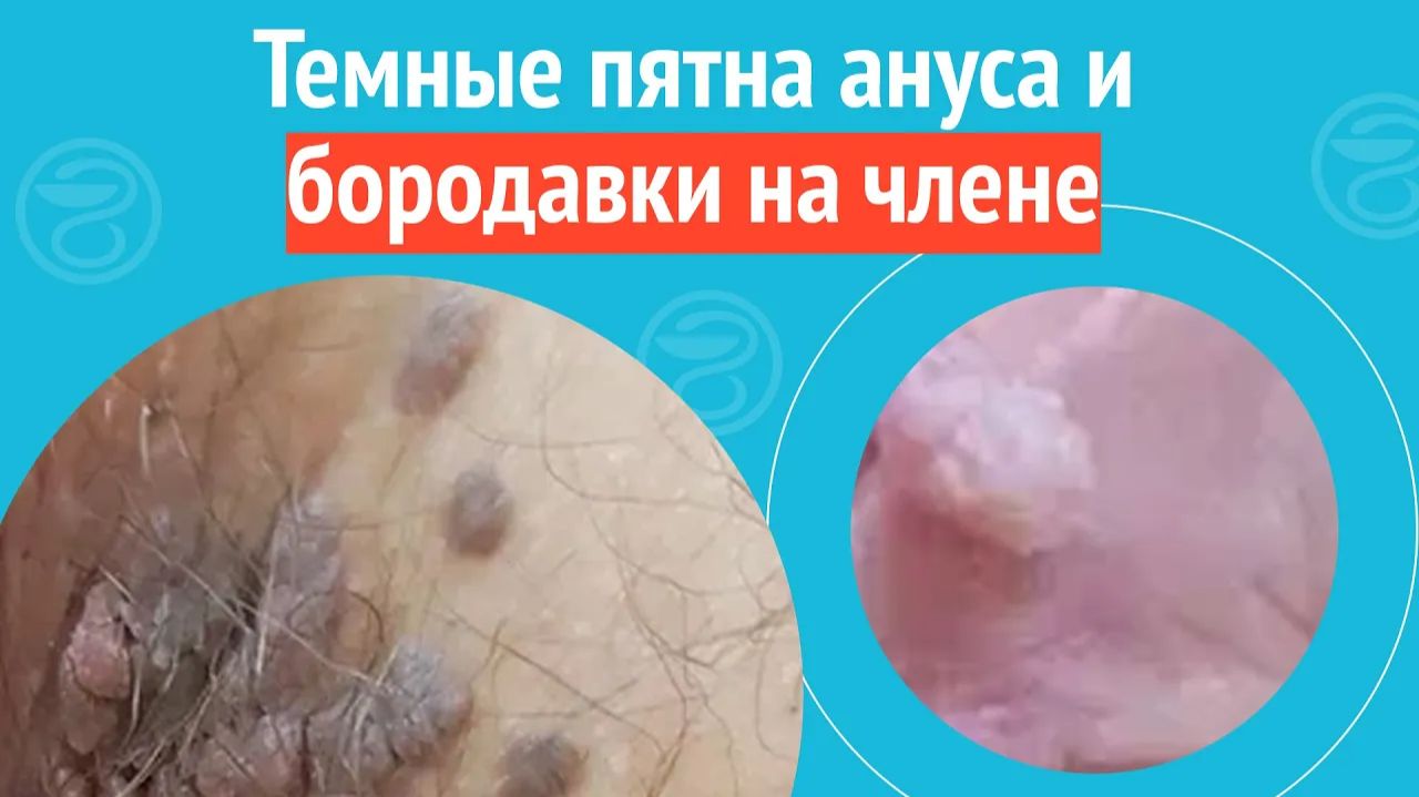 😟 Темные пятна ануса и бородавки на члене. Клинический случай №1296