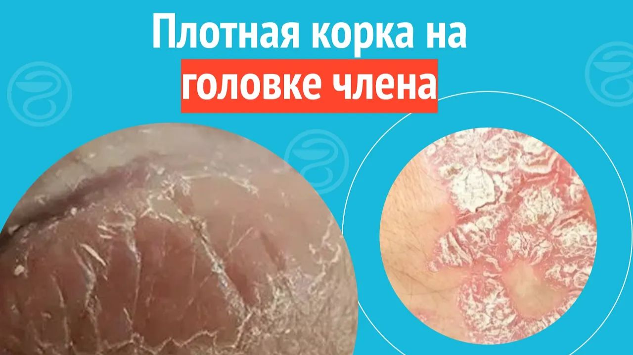 ➡️ Плотная корка на головке члена. Клинический случай №1293