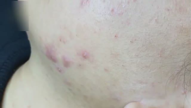 Удаление воспаленного акне - тотальная очистка