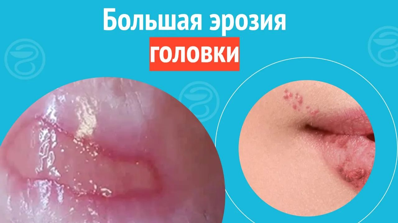 🥹 Большая эрозия головки. Клинический случай №1298