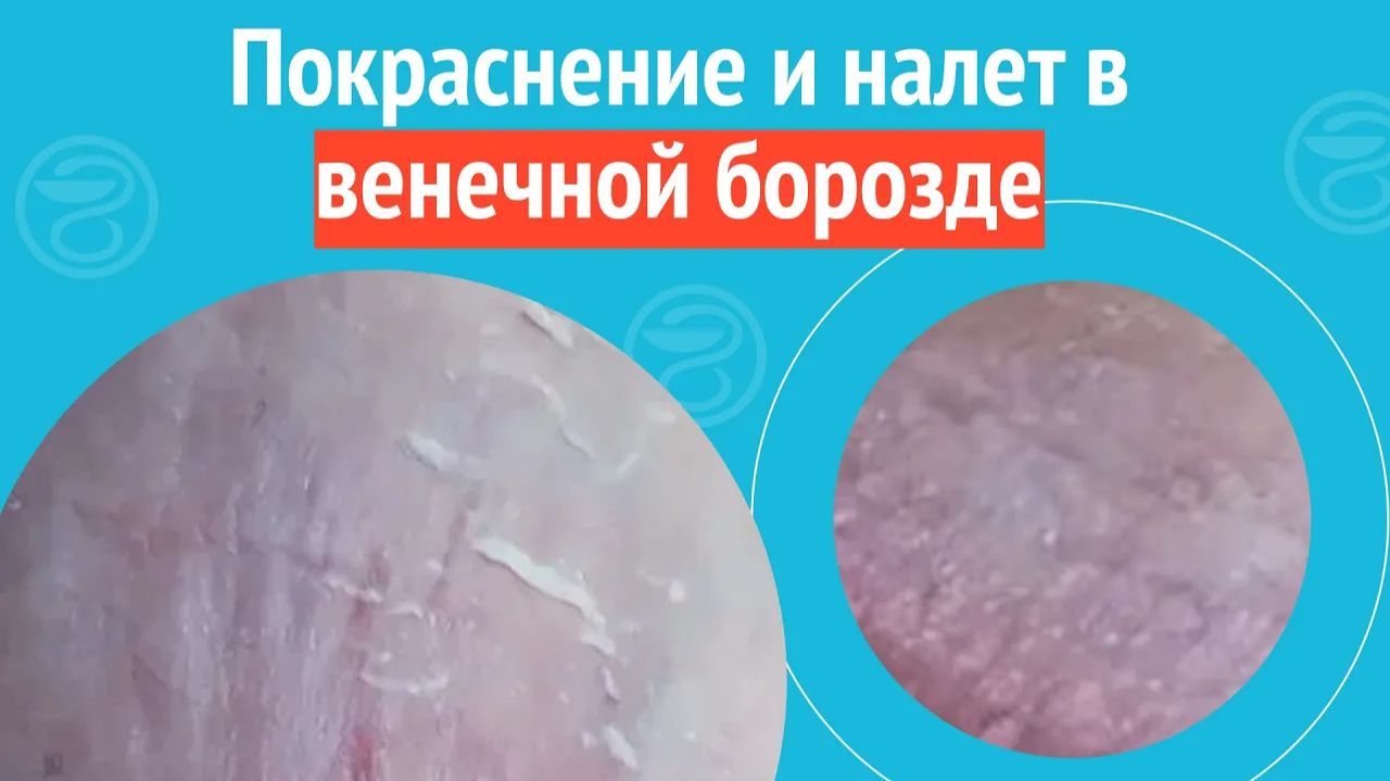 😐 Покраснение и налет в венечной борозде. Клинический случай №1295