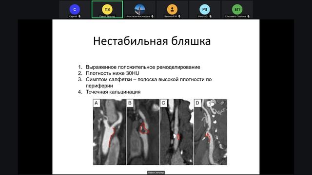 Патология сосудов КТ Зельтер