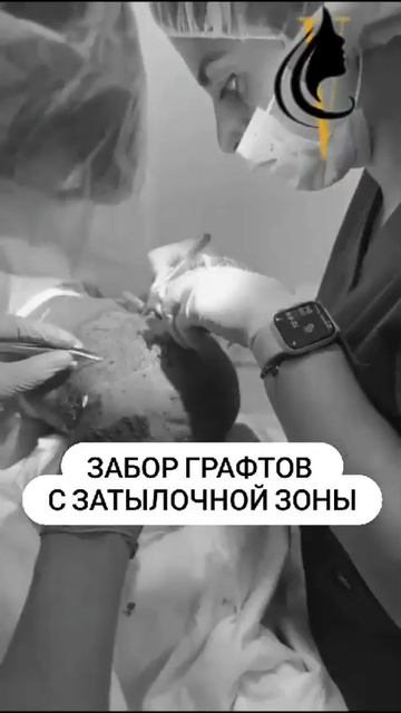 Процесс пересадки волос - забор графтов с затылочной зоны