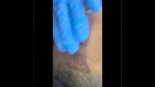 Удаление корочек на 10-й день после пересадки волос