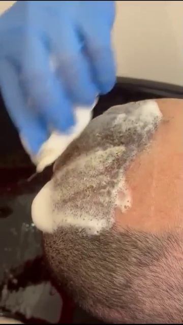 Пересадка волос - результат на 10 день