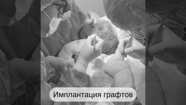 Процесс пересадки волос
