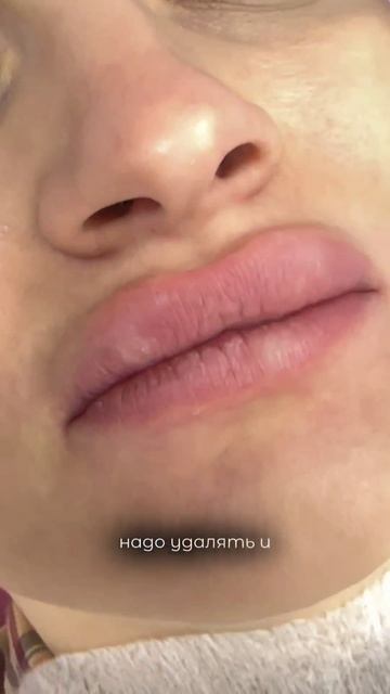 КАК УБРАТЬ МИГРИРОВАВШИЙ ФИЛЛЕР