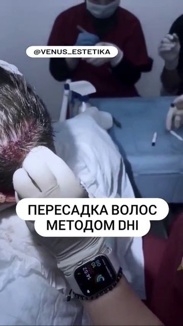 Пересадка волос методом DHI в Venus Estetika