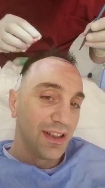 Во время пересадки волос!