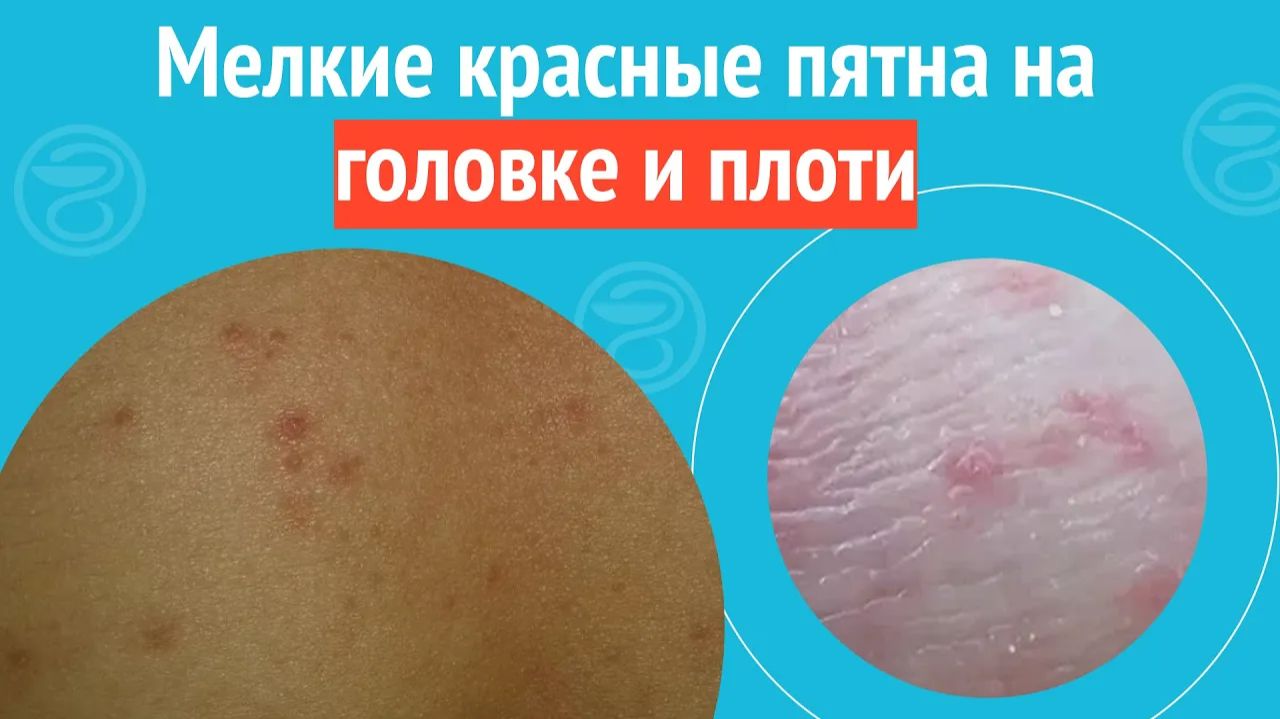 👉 Мелкие красные пятна на головке и плоти. Клинический случай №1284
