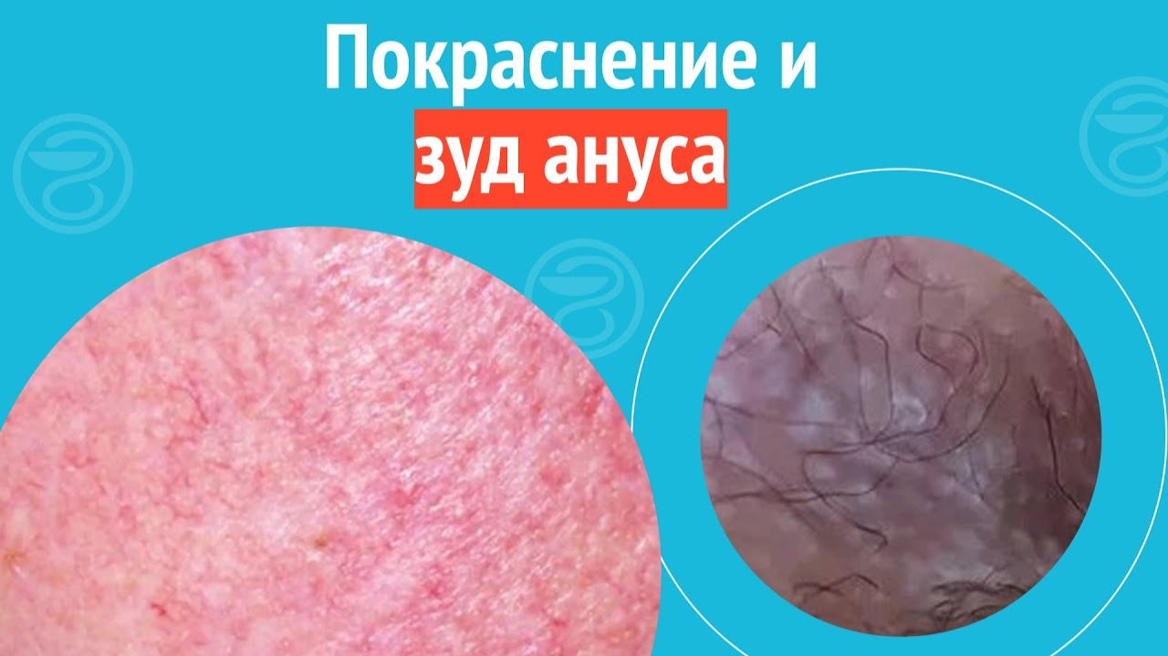 😡 Покраснение и зуд ануса. Клинический случай №1283