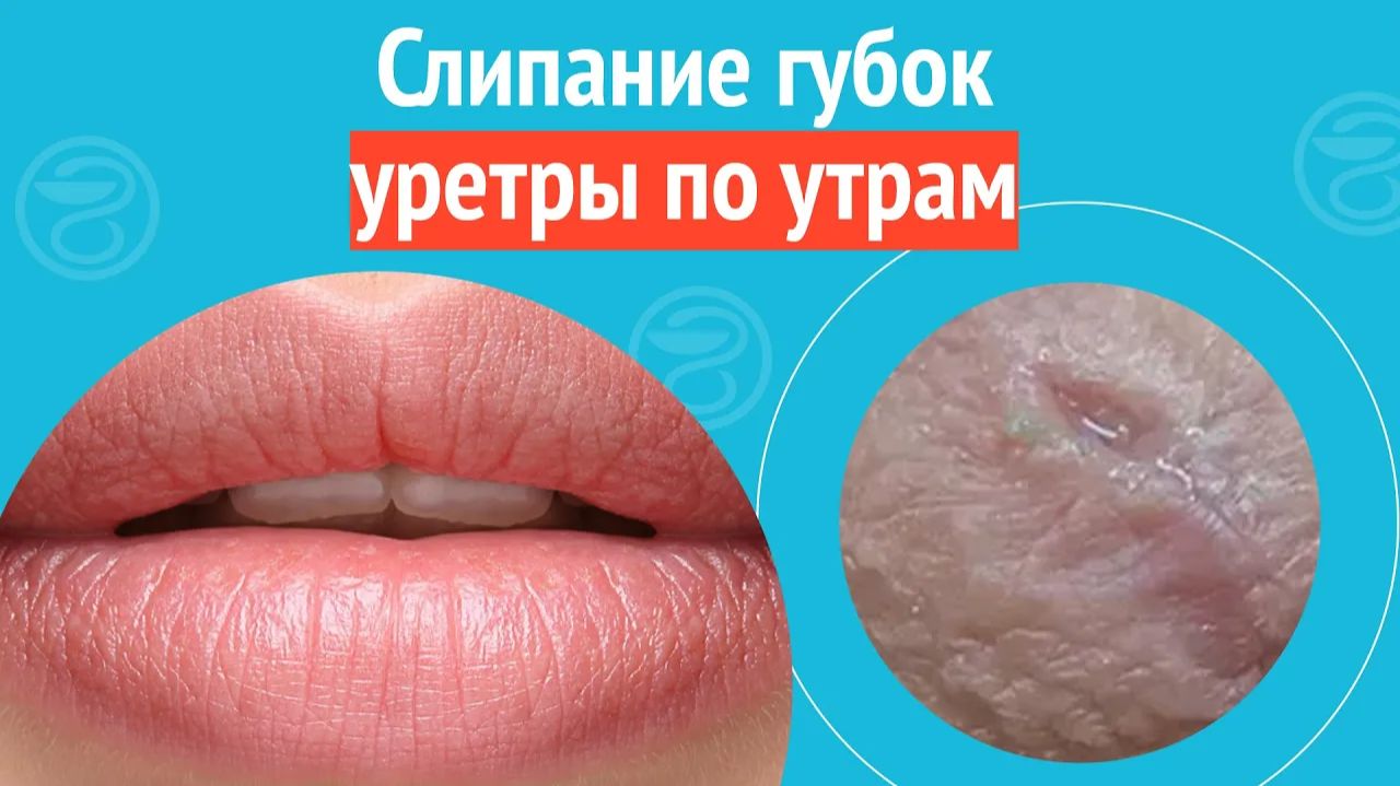 🥺 Слипание губок уретры по утрам. Клинический случай №1289