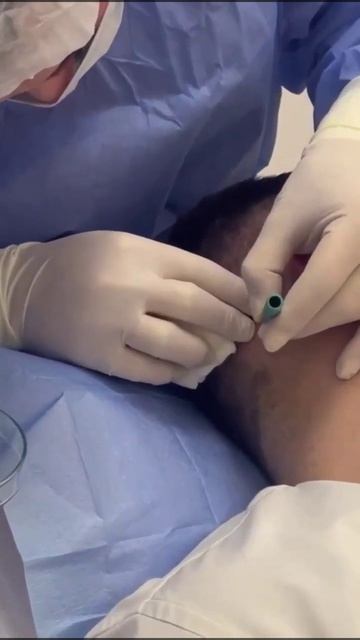 Regenera Activa - аутологичная процедура микротрансплантации при выпадении волос