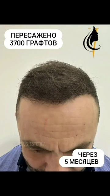 Пересадка волос по методу HFE | 3700 графтов