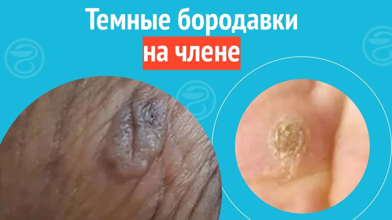 😠 Темные бородавки на члене. Клинический случай №1290