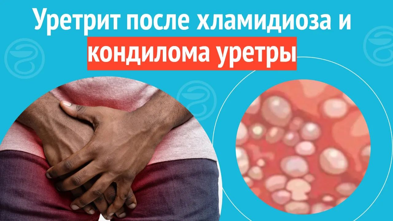 🙄 Уретрит после хламидиоза и кондилома уретры. Клинический случай №1287