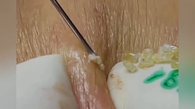 Выдавливание прыщей, угрей, черных точек и камедонов #365