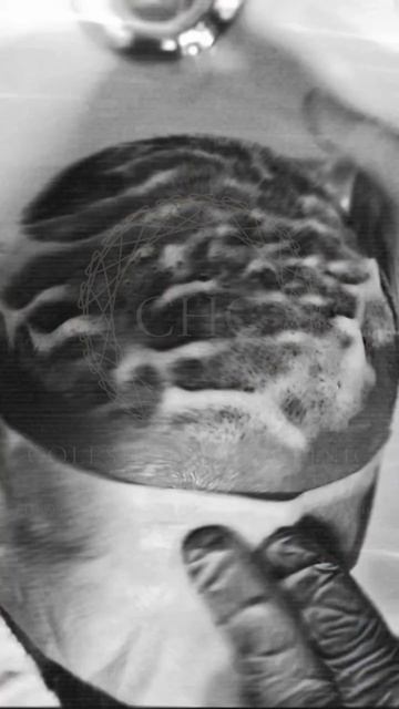 Пересадка волос на голове