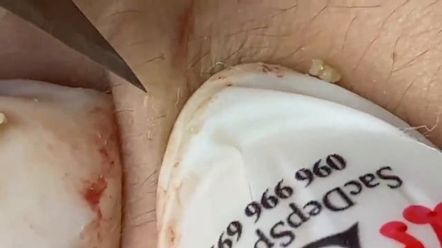 Выдавливание прыщей, угрей, черных точек и камедонов #367