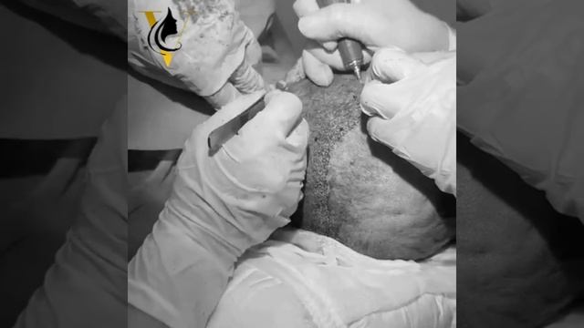 Пересадка волос - процесс забора графтов