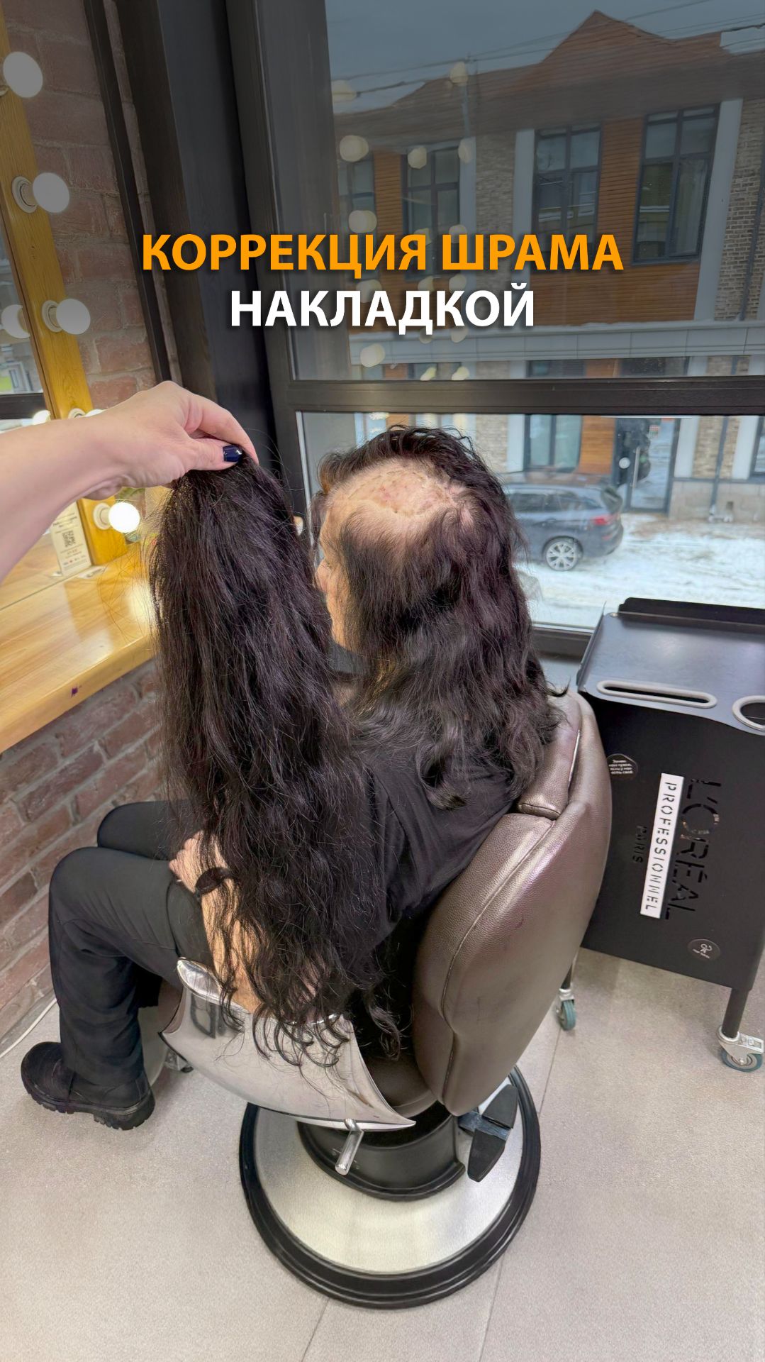 Коррекция шрама накладкой