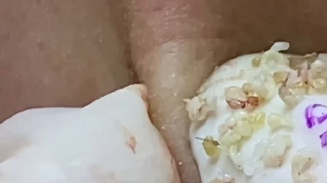 #268 Чистка лица от угрей и акне. Выдавливание прыщей. Удаление черных точек и комедонов