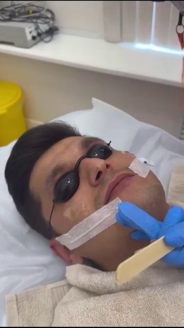 Корректирование формы бороды с помощью диодного лазера