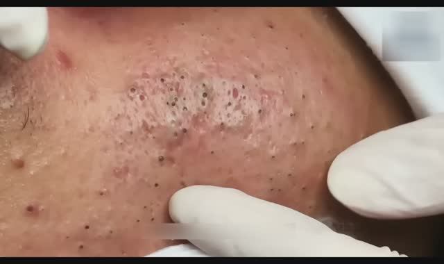 55 минут профессионального удаления черных точек  полный процесс