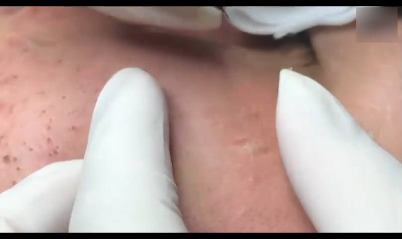 ASMR: услуга по лечению акне — расслабление и чистота