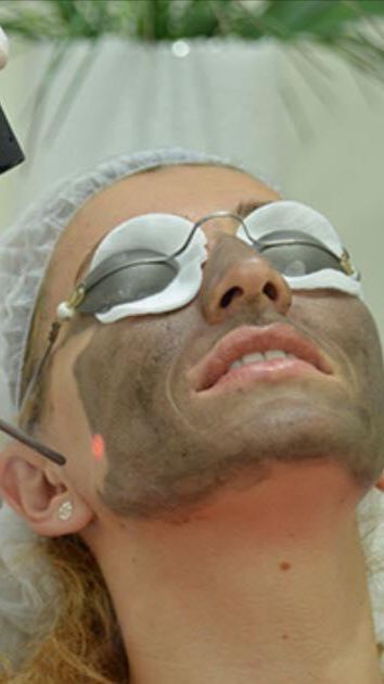 карбоновый пилинг..