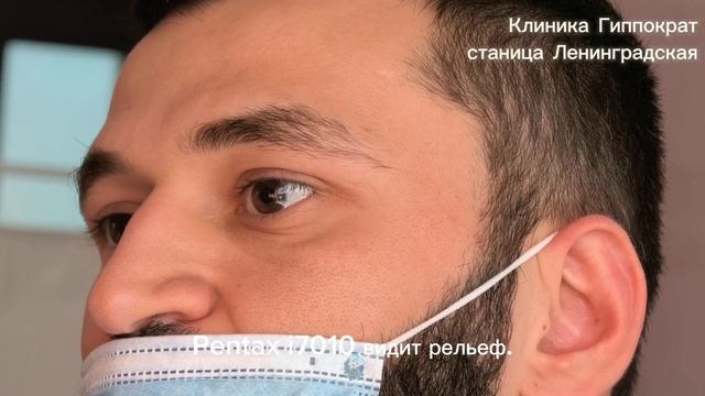  Что видит врач ВНУТРИ вас? Видеоколоноскопия на Pentax I7010 в ст. Ленинградской