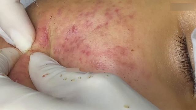 Удаление черных точек и белых угрей  чистка лица