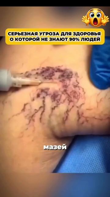 Китайский феномен: как избежать варикоза