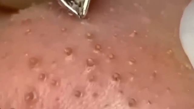 274 Чистка лица от угрей и акне. Выдавливание прыщей. Удаление черных точек и комедонов