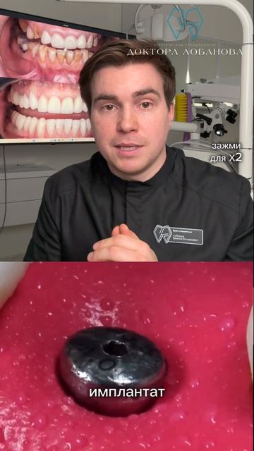 Многие заблуждаются что имплантат лучше чем свой зуб.