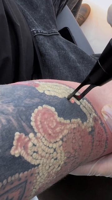 Аппарат для удаления тату