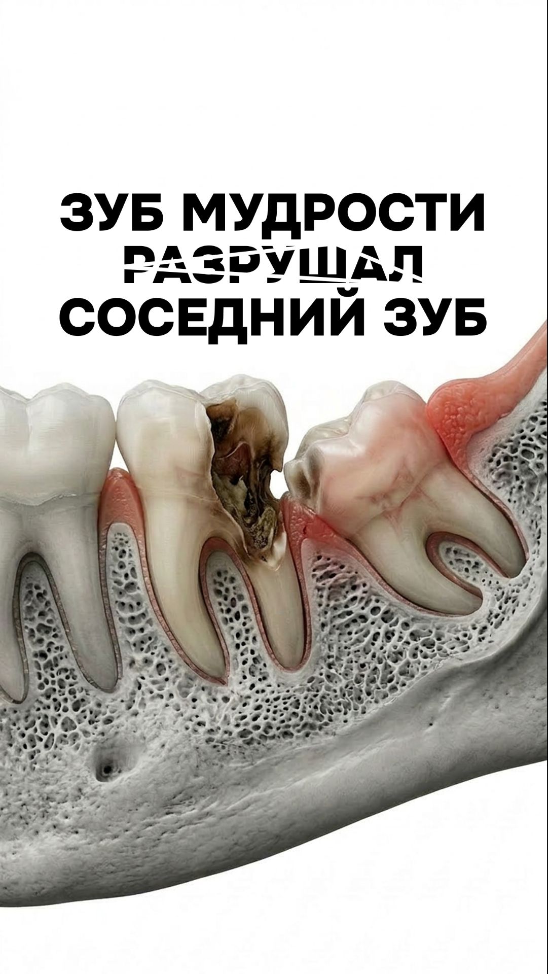 Зуб мудрости разушал соседний зуб