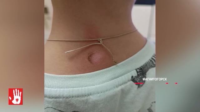 Подростку, корторый бросил окурок за шиворот трехлетнему ребенку, вынесли приговор