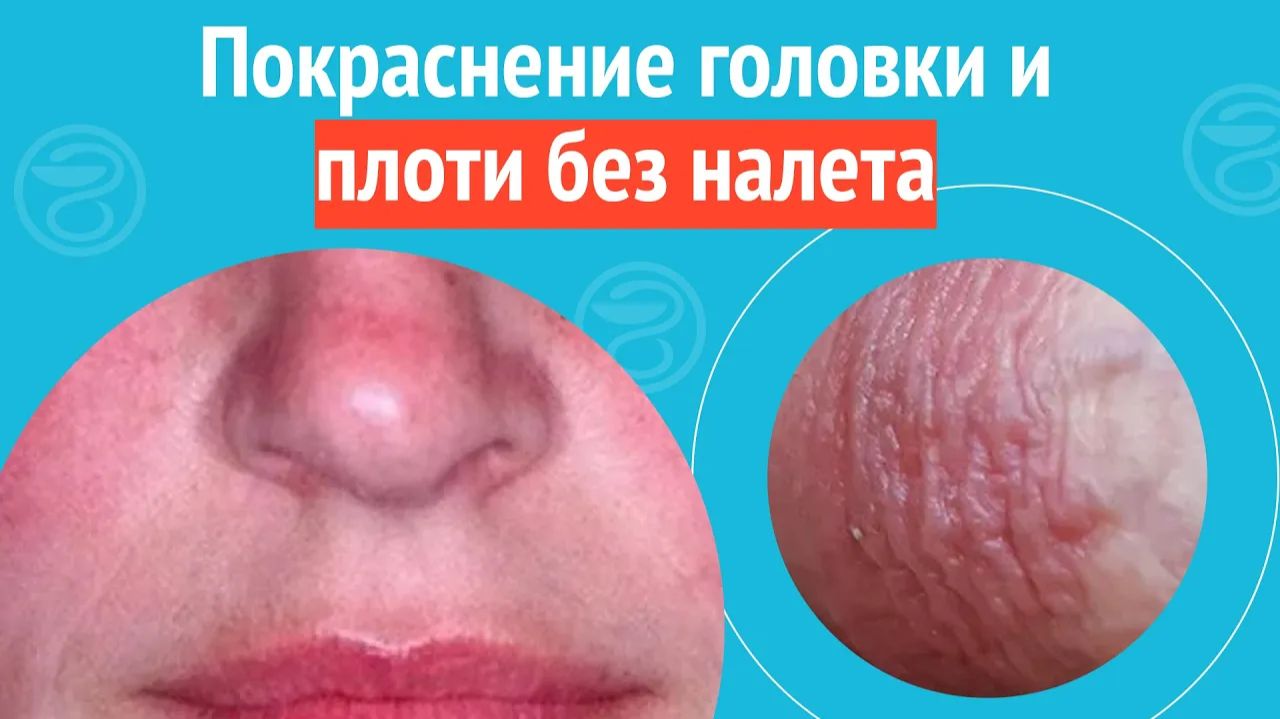 😡 Покраснение головки и плоти без налета. Клинический случай №1267