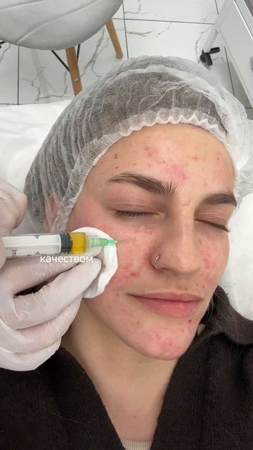 💬 История нашей пациентки на её пути к здоровой коже