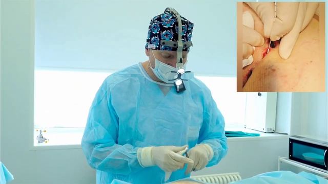 Живая лазерная хирургия кисты копчика